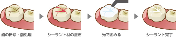 シーラント加工